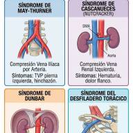 17 de diciembre: Día Mundial de los Síndromes Compresivos Vasculares