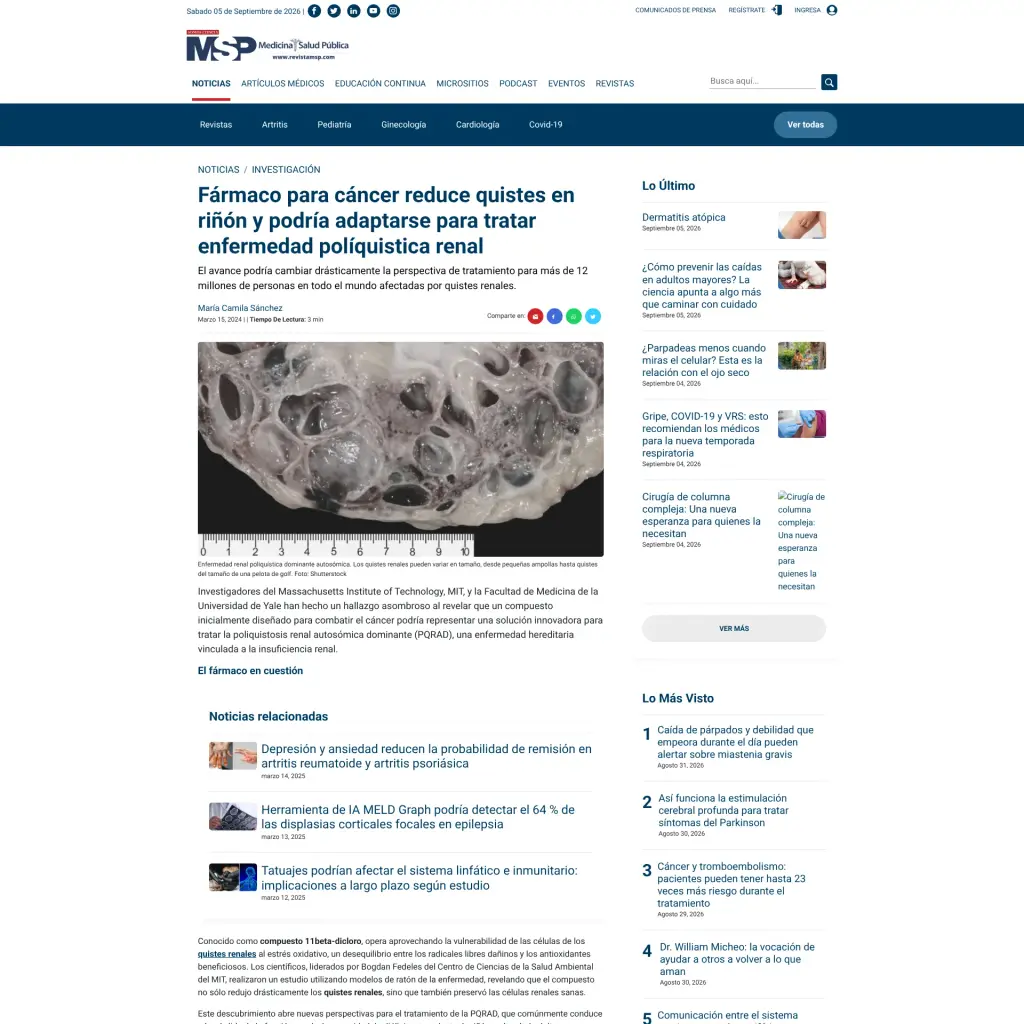 Fármaco para cáncer reduce quistes en riñón y podría adaptarse para tratar enfermedad políquistica renal
